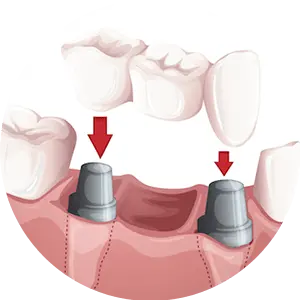 punti dentare