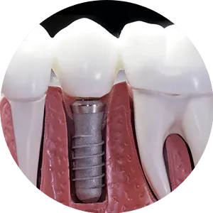 implant dentar